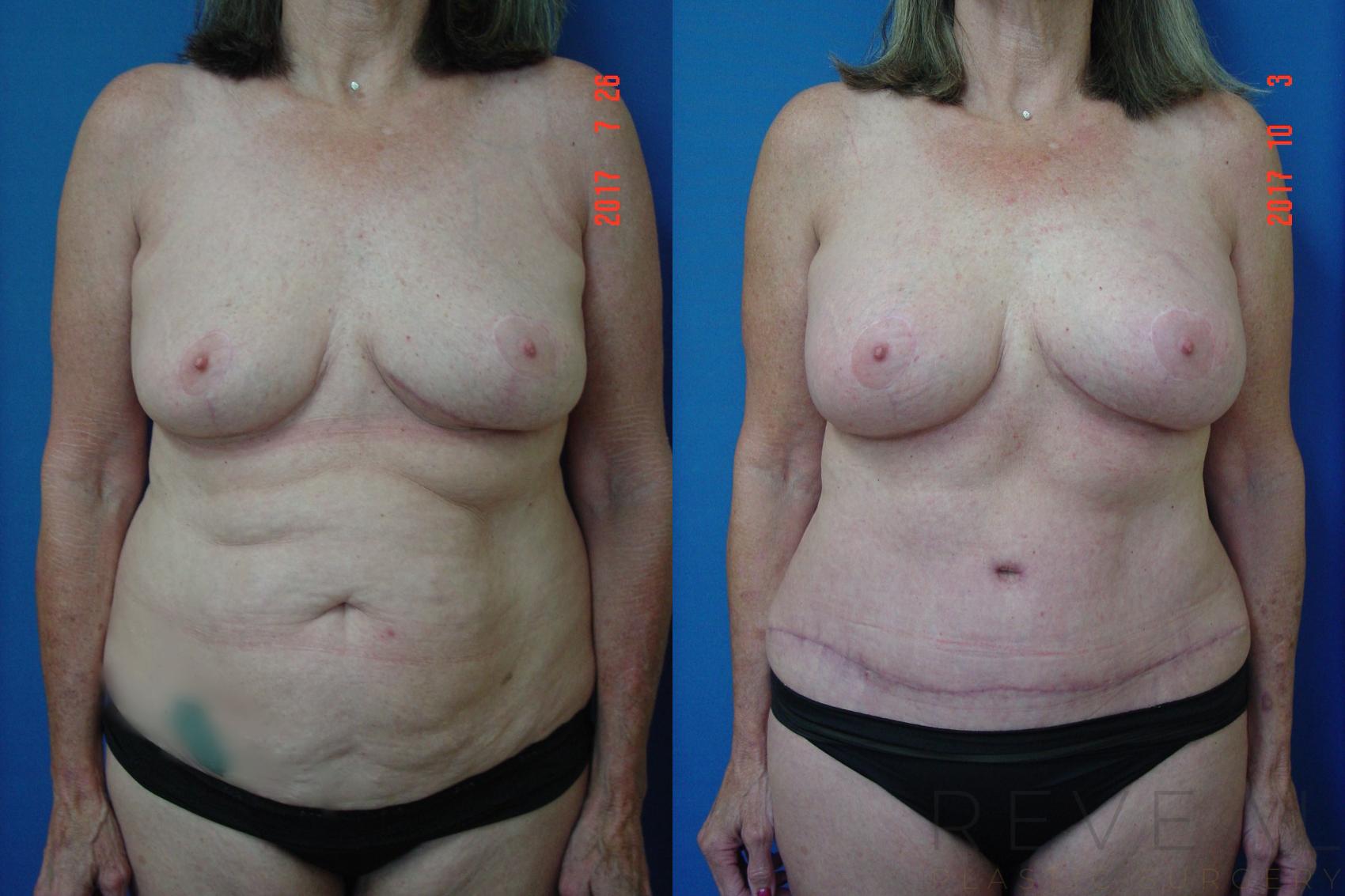 Before & After Liposuction Case 228 View #1 View in San Jose, CA