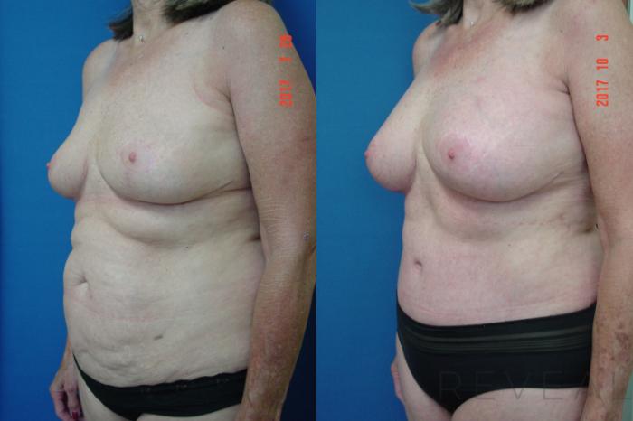 Before & After Liposuction Case 228 View #2 View in San Jose, CA