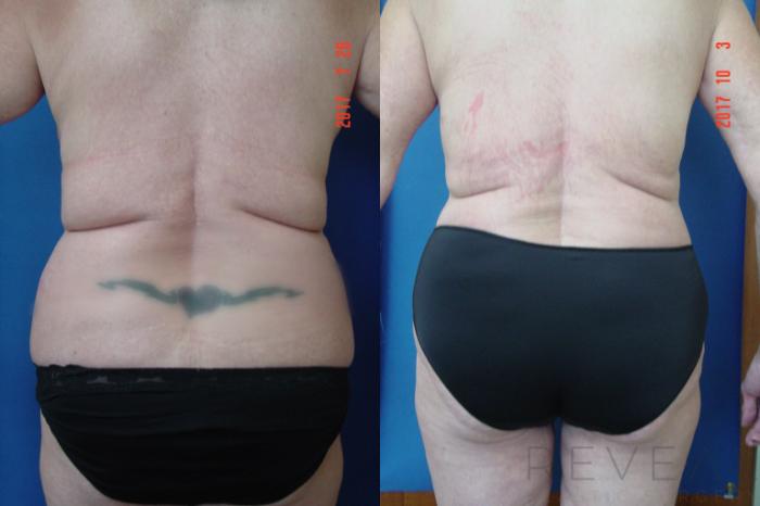 Before & After Brazilian Butt Lift Case 228 View #3 View in San Jose, CA