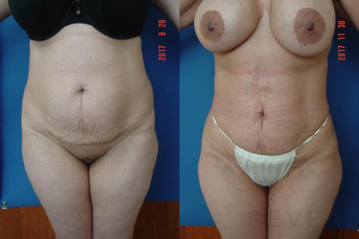 Before & After Brazilian Butt Lift Case 230 View #1 View in San Jose, CA