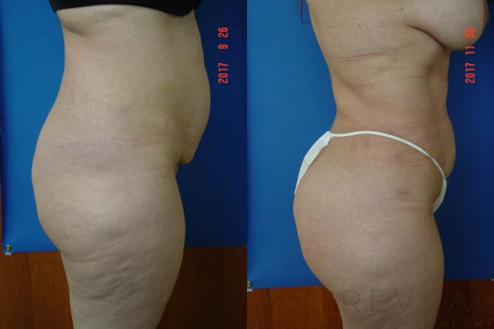 Before & After Liposuction Case 230 View #3 View in San Jose, CA