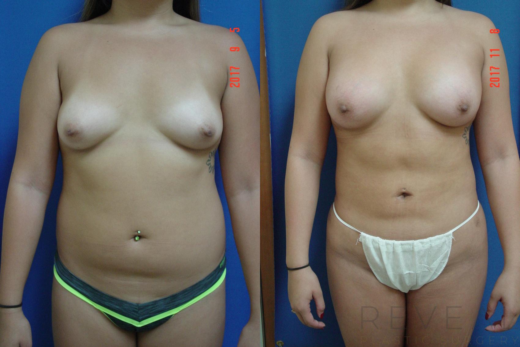 Before & After Breast Augmentation Case 231 View #1 View in San Jose, CA