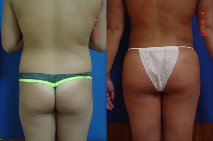 Before & After Liposuction Case 231 View #2 View in San Jose, CA