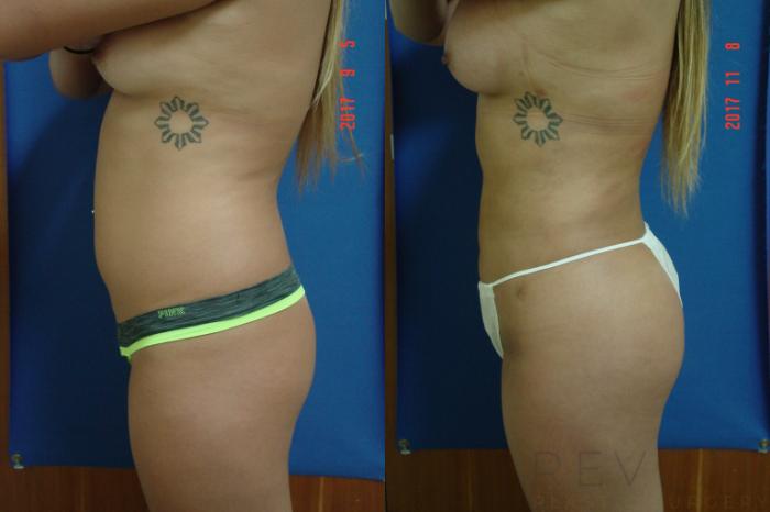 Before & After Liposuction Case 231 View #3 View in San Jose, CA