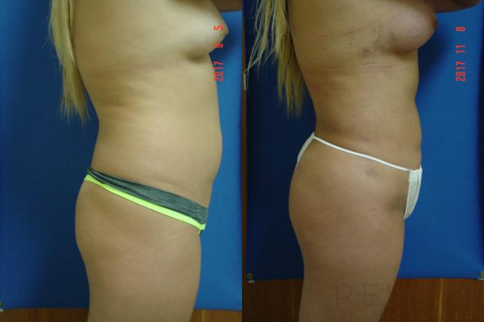 Before & After Brazilian Butt Lift Case 231 View #4 View in San Jose, CA
