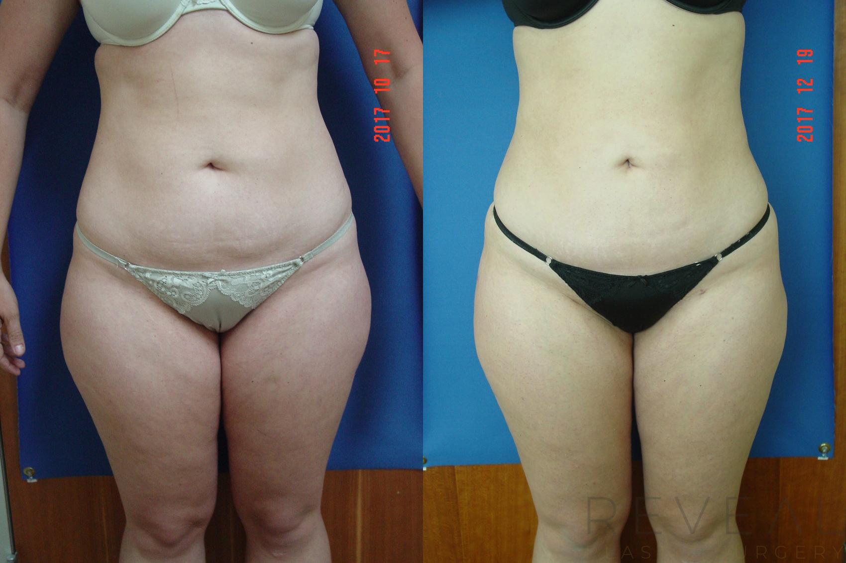 Before & After Liposuction Case 235 View #1 View in San Jose, CA