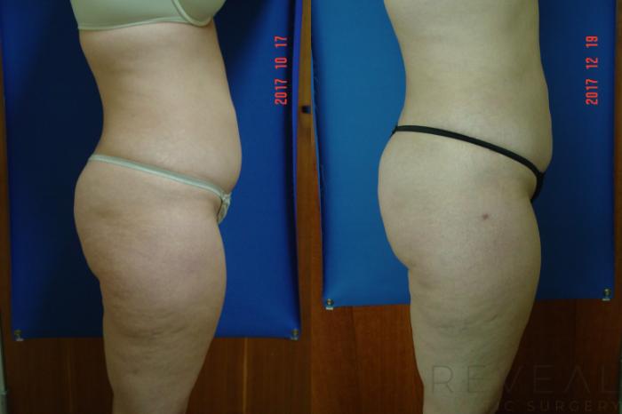 Before & After Liposuction Case 235 View #2 View in San Jose, CA