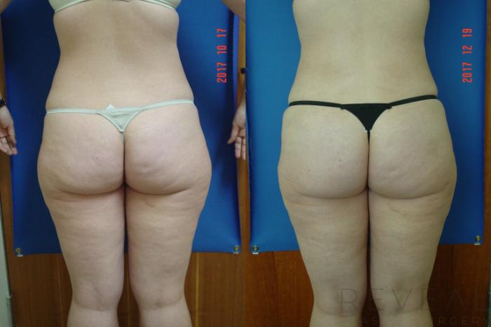 Before & After Liposuction Case 235 View #3 View in San Jose, CA