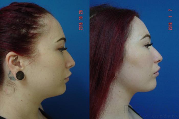 Before & After Liposuction Case 315 View #1 View in San Jose, CA