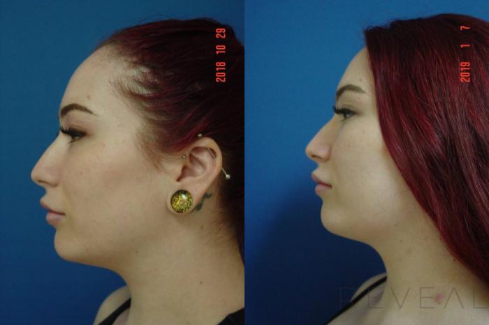 Before & After Liposuction Case 315 View #2 View in San Jose, CA