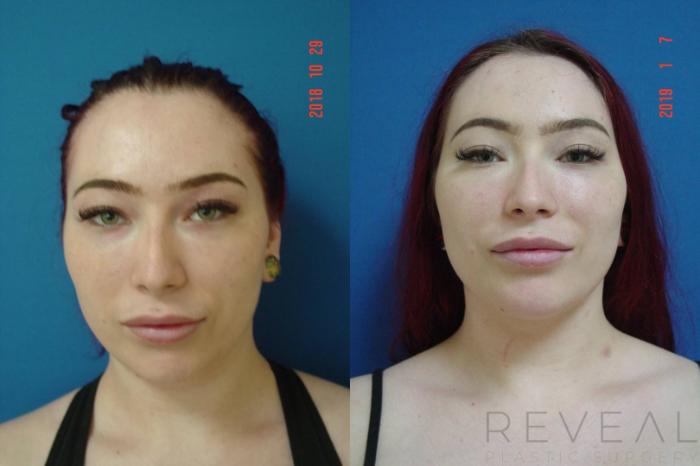 Before & After Liposuction Case 315 View #3 View in San Jose, CA