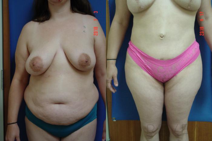 Before & After Liposuction Case 326 View #1 View in San Jose, CA