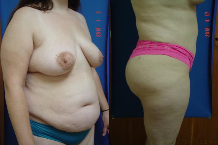 Before & After Liposuction Case 326 View #3 View in San Jose, CA