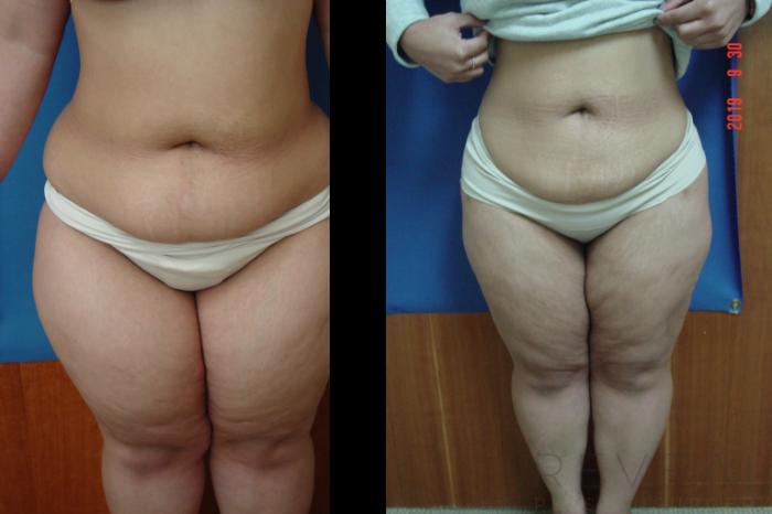 Before & After Liposuction Case 366 View #1 View in San Jose, CA