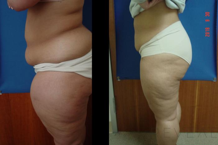 Before & After Liposuction Case 366 View #2 View in San Jose, CA