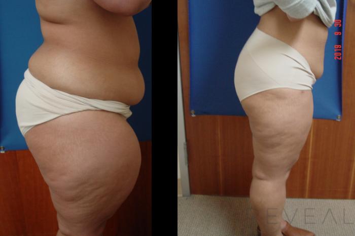 Before & After Liposuction Case 366 View #3 View in San Jose, CA