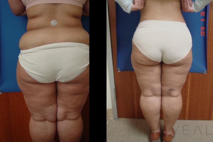 Before & After Liposuction Case 366 View #4 View in San Jose, CA