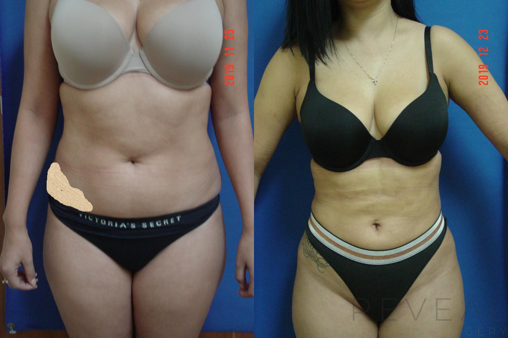 Before & After Liposuction Case 385 View #1 View in San Jose, CA