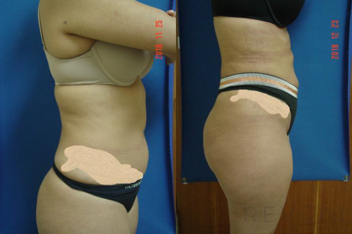 Before & After Liposuction Case 385 View #3 View in San Jose, CA