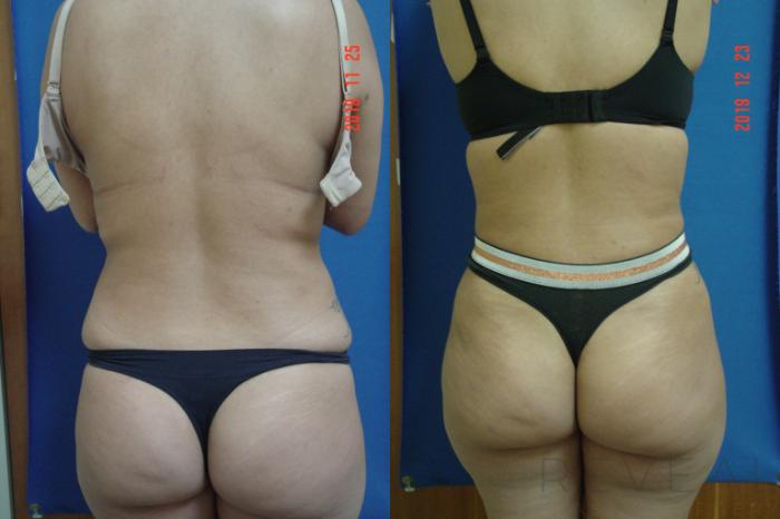 Before & After Liposuction Case 385 View #4 View in San Jose, CA