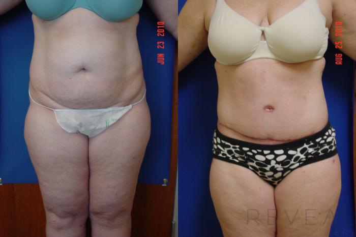 Before & After Tummy Tuck Case 41 View #1 View in San Jose, CA