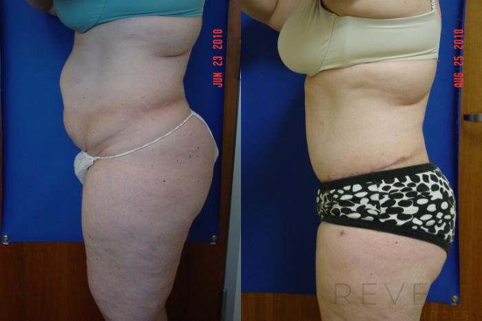 Before & After Tummy Tuck Case 41 View #2 View in San Jose, CA