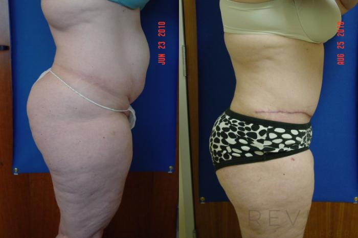 Before & After Tummy Tuck Case 41 View #3 View in San Jose, CA