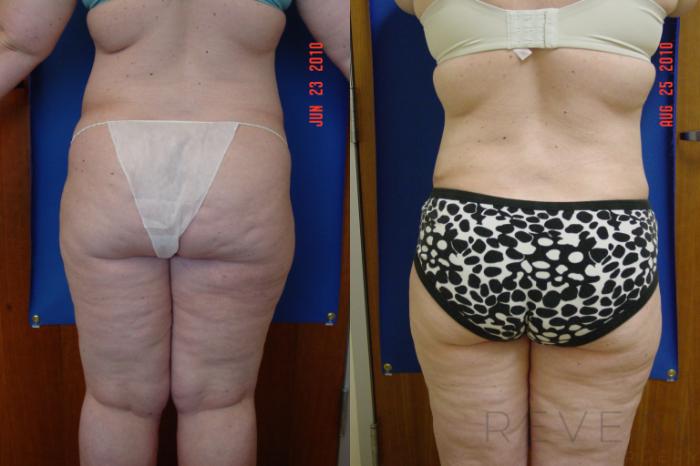 Before & After Liposuction Case 41 View #4 View in San Jose, CA