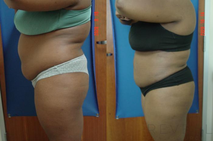 Before & After Liposuction Case 440 View #2 View in San Jose, CA