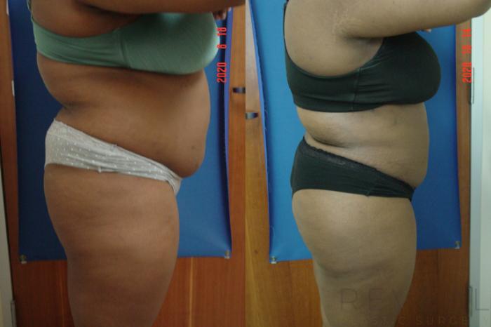 Before & After Liposuction Case 440 View #3 View in San Jose, CA