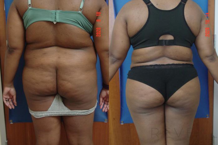 Before & After Liposuction Case 440 View #4 View in San Jose, CA