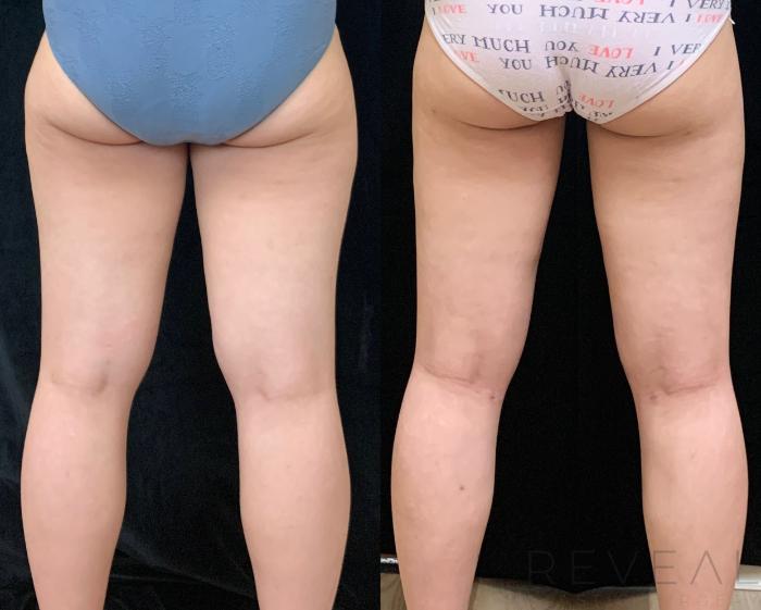 Before & After Liposuction Case 465 View #1 View in San Jose, CA