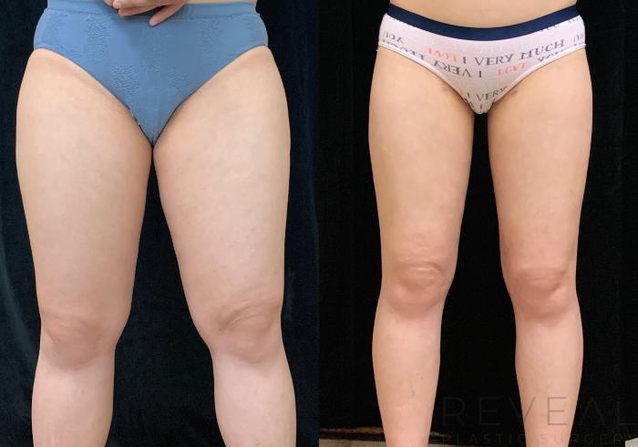 Before & After Liposuction Case 465 View #2 View in San Jose, CA