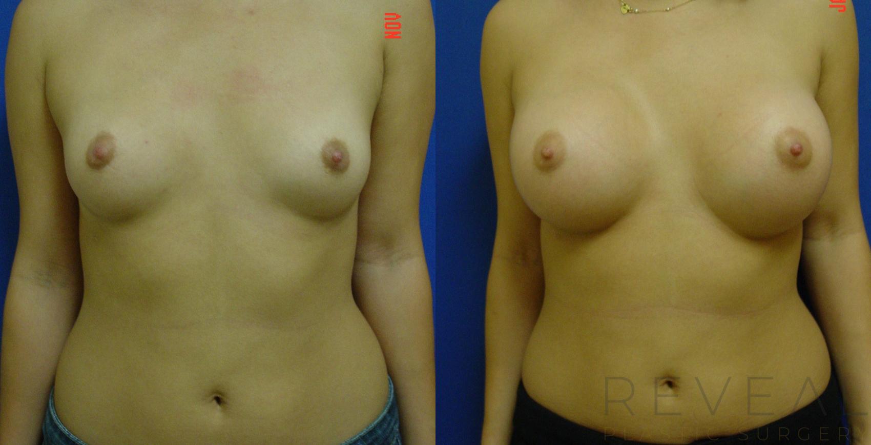 Before & After Breast Augmentation Case 48 View #1 View in San Jose, CA