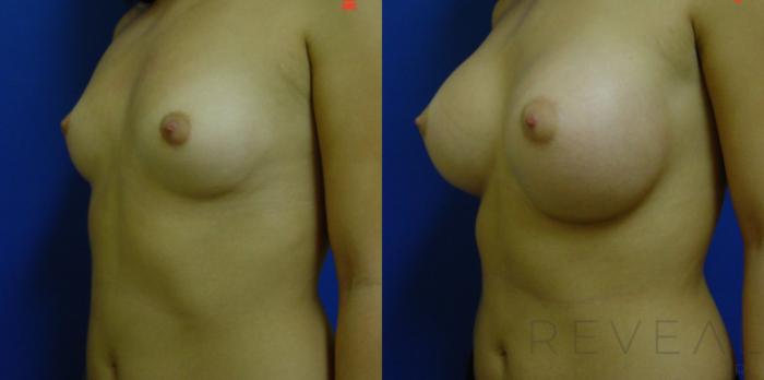 Before & After Breast Augmentation Case 48 View #2 View in San Jose, CA