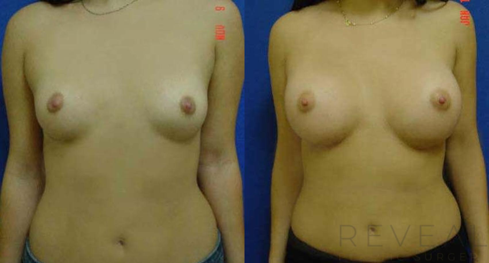 Before & After Breast Augmentation Case 49 View #1 View in San Jose, CA