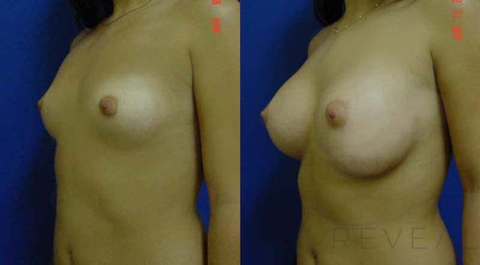 Before & After Breast Augmentation Case 49 View #2 View in San Jose, CA