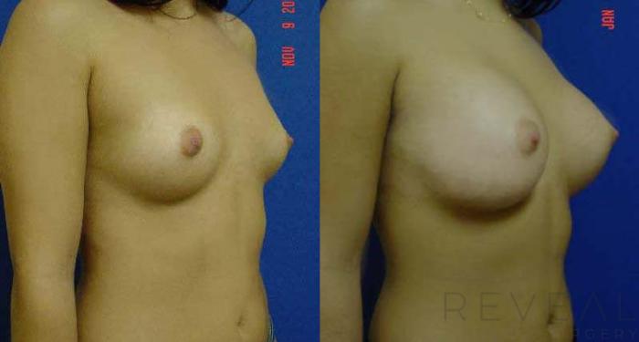 Before & After Breast Augmentation Case 49 View #3 View in San Jose, CA