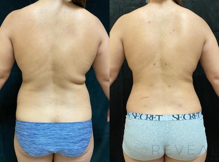 Before & After Liposuction Case 518 View #1 View in San Jose, CA