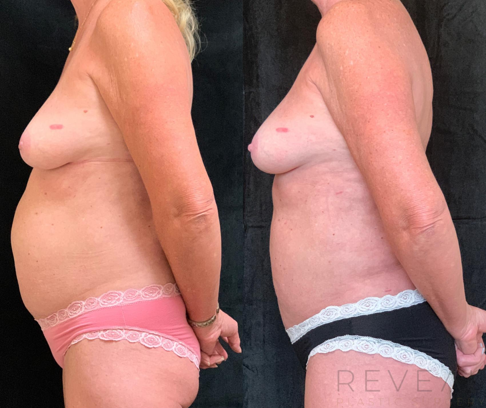 Before & After Liposuction Case 520 View #1 View in San Jose, CA