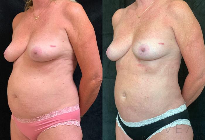 Before & After Liposuction Case 520 View #2 View in San Jose, CA