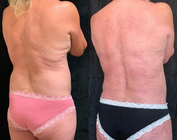 Before & After Liposuction Case 520 View #3 View in San Jose, CA