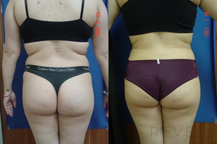 Before & After Brazilian Butt Lift Case 523 View #1 View in San Jose, CA