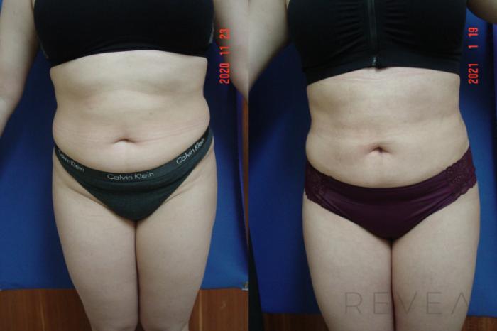 Before & After Liposuction Case 523 View #2 View in San Jose, CA
