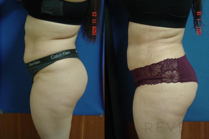 Before & After Liposuction Case 523 View #3 View in San Jose, CA