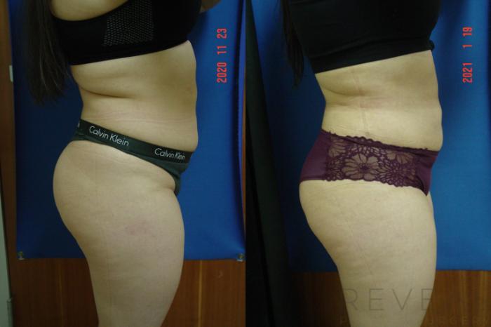 Before & After Brazilian Butt Lift Case 523 View #4 View in San Jose, CA