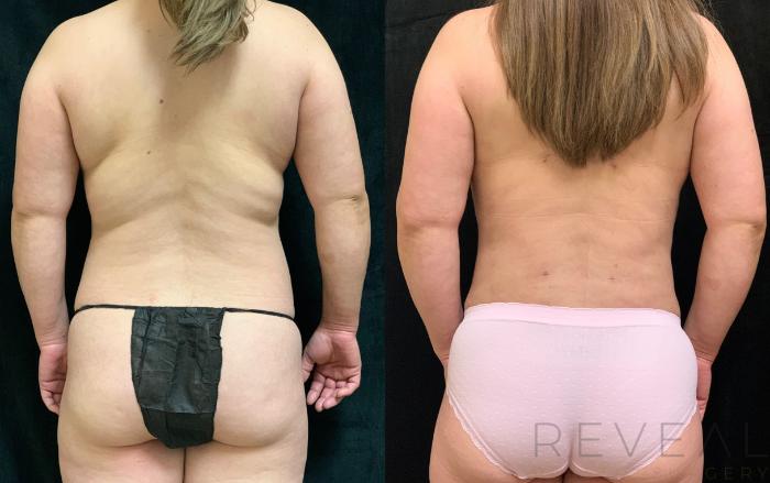 Before & After Liposuction Case 529 View #1 View in San Jose, CA