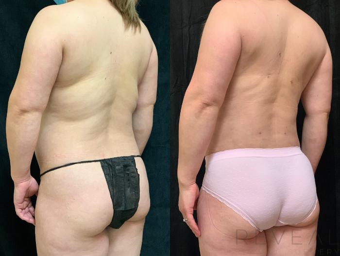 Before & After Liposuction Case 529 View #2 View in San Jose, CA
