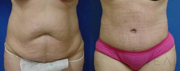 Before & After Liposuction Case 53 View #1 View in San Jose, CA