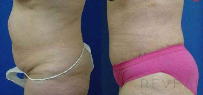 Before & After Tummy Tuck Case 53 View #2 View in San Jose, CA